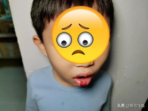 小朋友在上課時被人推倒，嘴巴被磕破流血了還一直腫著