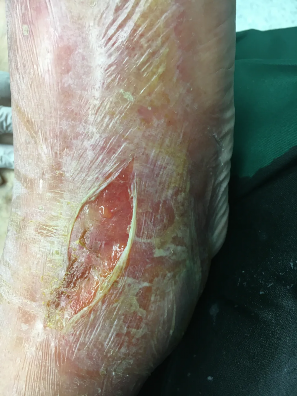 一隻梭子蟹，寧波大叔差點截肢喪命！這種“吃進去”的細菌太可怕