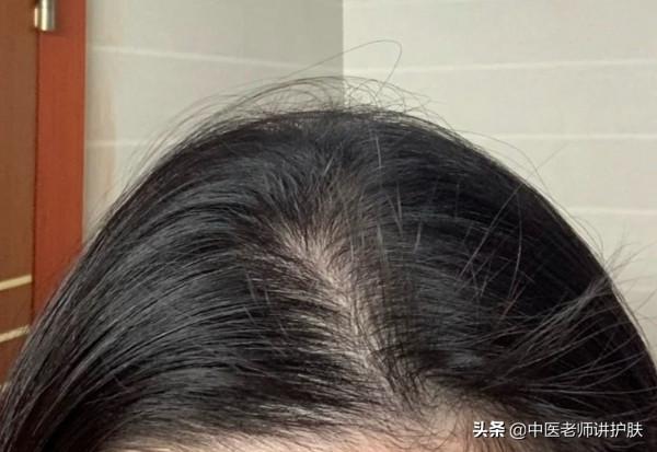 頭髮出油？是“痰溼”漂上來！送你兩個方子，一方化痰，一方生髮