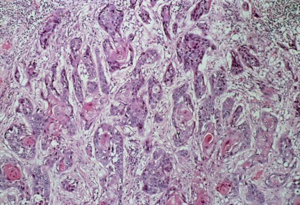 42歲男子咳嗽3個月後，突然覺得胸痛，到醫院活檢，結果是肺鱗癌
