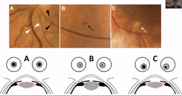 COVID-19眼部感染，何為真？何為假？丨APVRS 2021