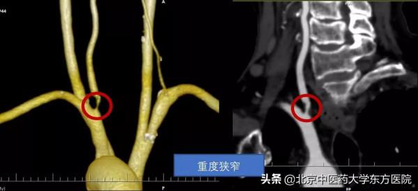 【醫學小常識】有一種眩暈需要格外注意