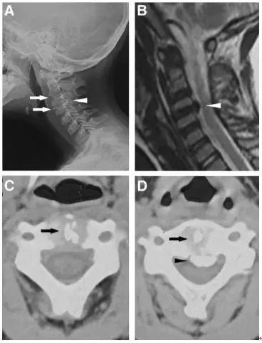 頸椎少見的3種鈣化性疾病 頸椎少見的3種鈣化性疾病