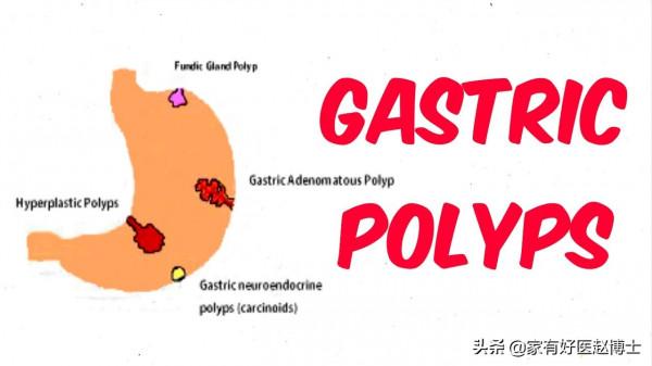 最常見5類息肉每個人都可能有，哪些無癌變風險，哪些需要切除？