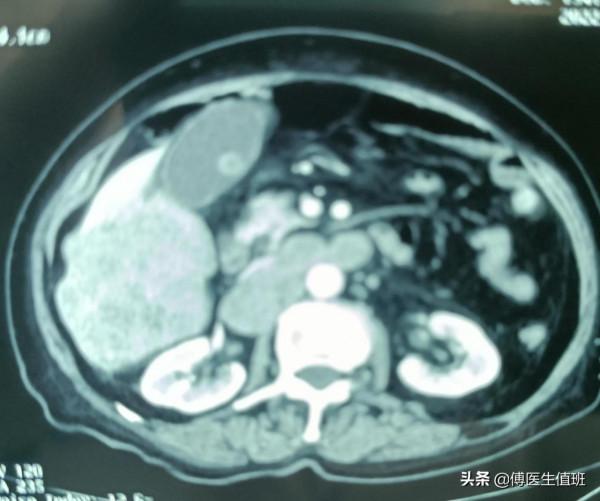 女子腹痛，疑為膽囊炎，檢查發現肝臟多發腫瘤，醫生：差點誤診