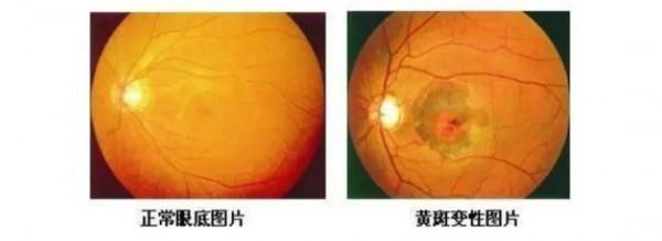 中老年眼病如何防治？聽聽專家怎麼說→