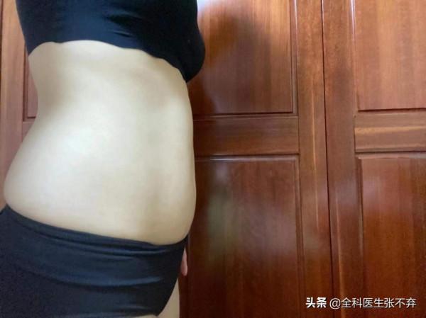 度拉糖肽減肥再記 度拉糖肽減肥再記