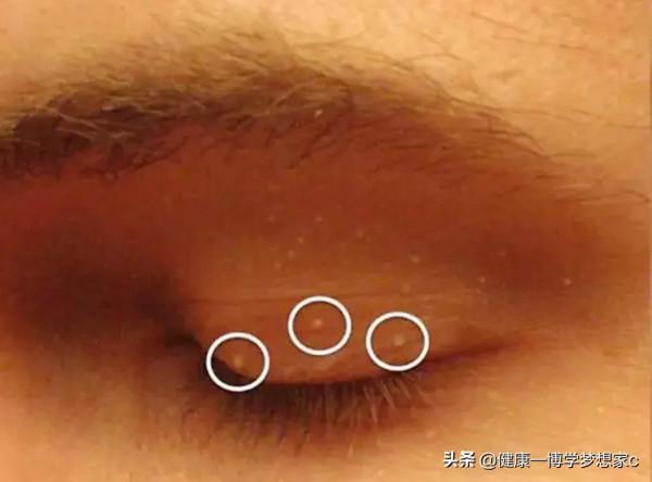 眼睛周圍的脂肪粒其實是粟丘疹，教你兩個方法輕鬆祛除它