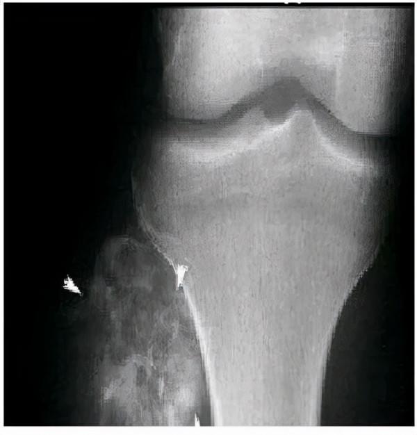 你以為孩子是“生長痛”，誰知竟會是骨腫瘤