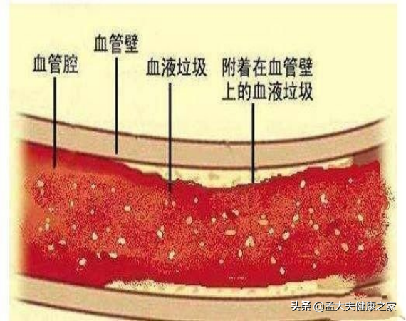 長期服用阿司匹林和他汀，是在治療腦梗死嗎，真正目的是什麼？