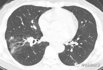 咳嗽半年反覆肺炎為什麼治不好 細看影像發現端倪緣是異物堵塞
