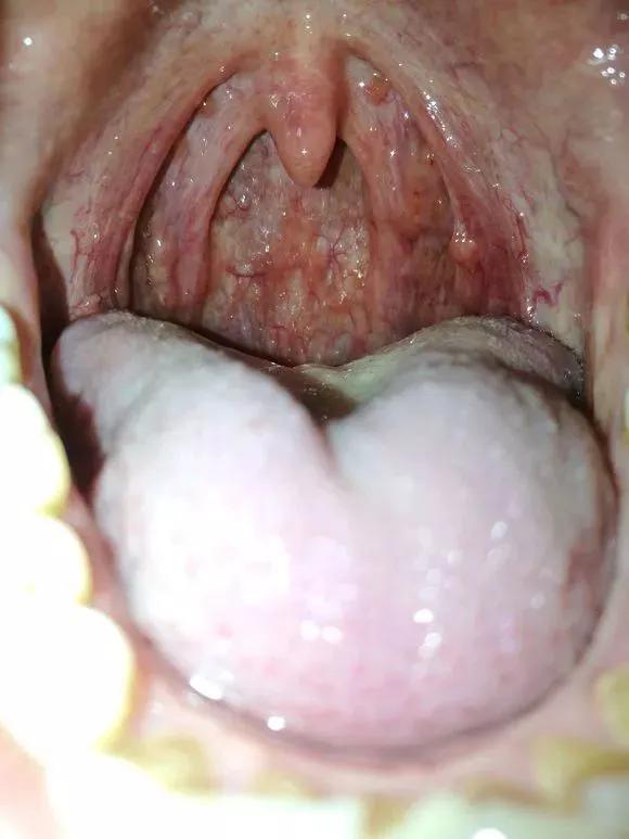 慢性咽炎的病因病機,臨床表現及中藥及中藥治療 慢性咽炎的病因病機,臨床表現及中藥及中藥治療