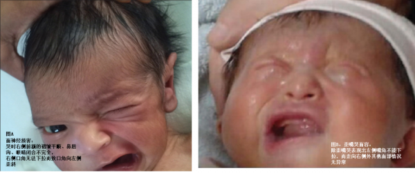 為什麼寶寶哭時,歪斜嘴巴總往一側歪斜 為什麼寶寶哭時,歪斜嘴巴總往一側歪斜