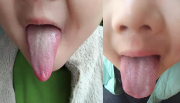 小兒反覆感冒，中醫從脾虛食積論治，療效顯著