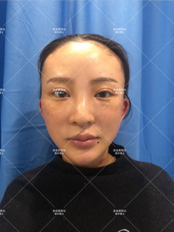 32歲公開做小拉皮+頸闊肌成形手術全過程,速來圍觀 32歲公開做小拉皮+頸闊肌成形手術全過程,速來圍觀