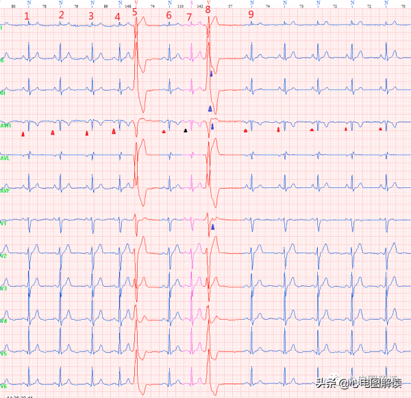 室性早搏?房性早搏?室房逆傳? 室性早搏?房性早搏?室房逆傳?