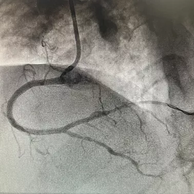 再克技術堡壘，巧破閉塞病變