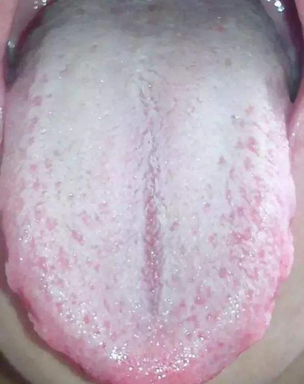 中醫論治糖尿病，不同證型的糖尿病該如何治療？快看看你是哪一種