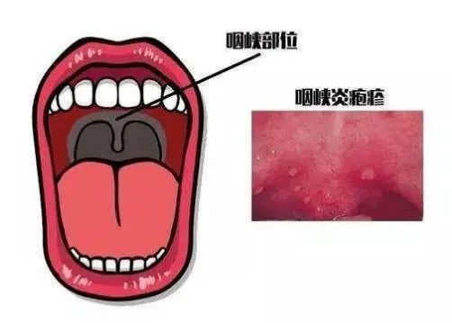 疾控話健康｜皰疹性咽峽炎是手足口病的“近親”？