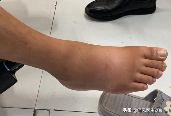 痛風不會無緣無故出現，尿酸高請注意避開痛風發作的十大誘因