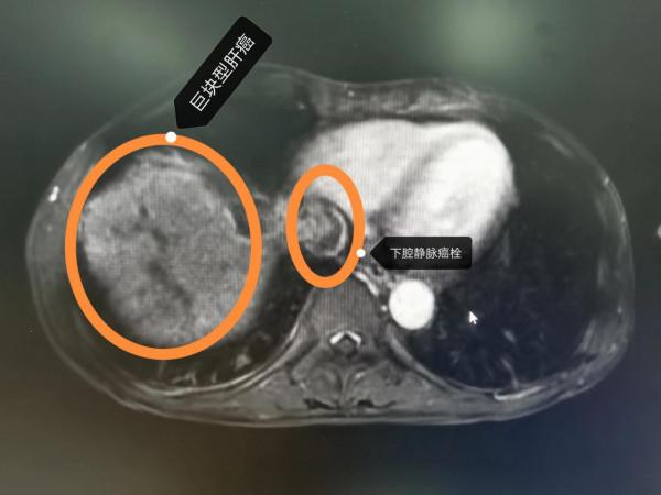 晚期肝癌的介入治療