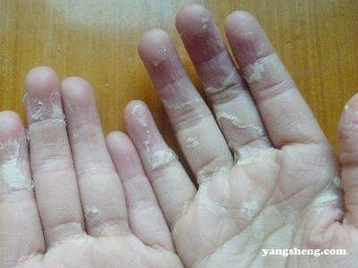 手蛻皮、長白髮、長痘痘您有可能是血熱 手蛻皮、長白髮、長痘痘您有可能是血熱