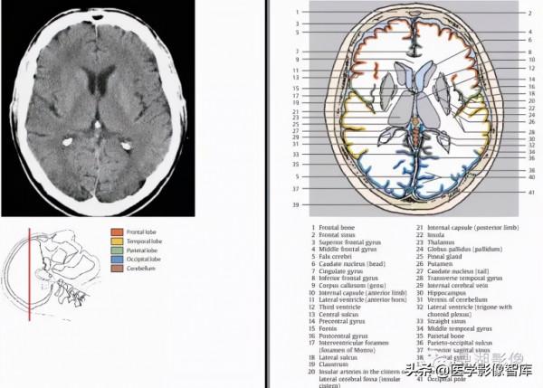 CT斷層解剖圖譜最全總結「推薦收藏」 CT斷層解剖圖譜最全總結「推薦收藏」
