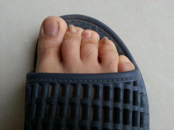 很多人都有嵌甲，一碰就疼？在家試試這個小妙招，或許有用