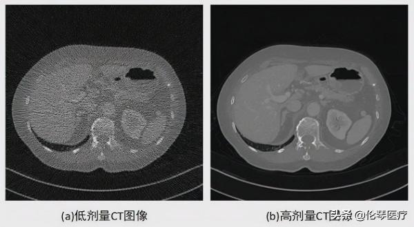 影像醫學前沿 &vert; 磁共振準確識別水腫心肌、全自動椎體骨折AI影像