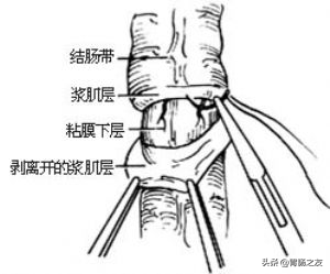 女老師反覆腹痛、便秘兩年,差點開腹切腸子,一查腸鏡原因找到了 女老師反覆腹痛、便秘兩年,差點開腹切腸子,一查腸鏡原因找到了