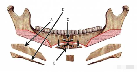 那些一刀切削骨的明星還好嗎?後遺症一大堆,小方臉成最大贏家 那些一刀切削骨的明星還好嗎?後遺症一大堆,小方臉成最大贏家