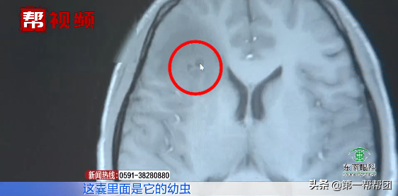 喜食切片生肉，二十歲小夥突發癲癇險致命！元兇竟是一種蟲