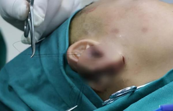 再造耳餘文林博士科普:28歲還可以耳朵做手術嗎? 再造耳餘文林博士科普:28歲還可以耳朵做手術嗎?