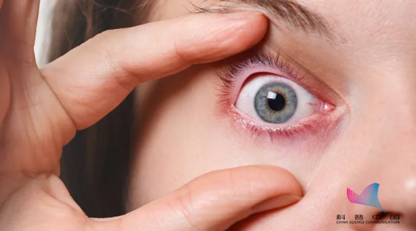 警惕！出現這樣的“紅眼”一定要當心！嚴重或可致盲