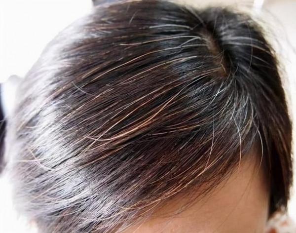 為什麼白頭髮越長越多？你以為是老了，醫生：或是缺乏2種營養素