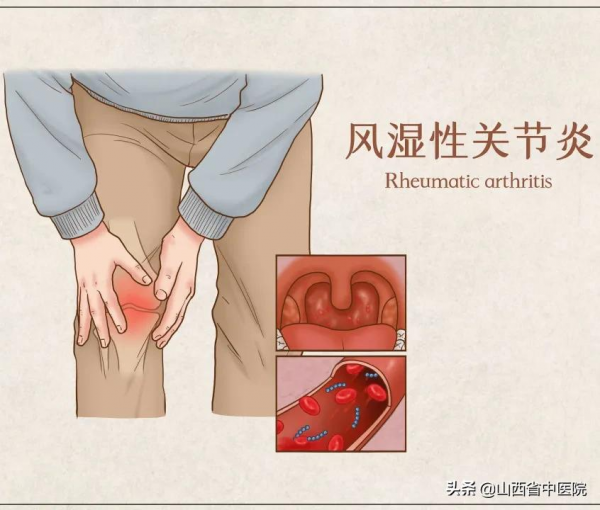 一變天就關節痛，風溼病該如何調理？這個方法或許能派上用場