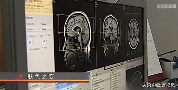 真實故事:山西45歲女子一夜變黑,體重急速增加,手術後讓家人落淚