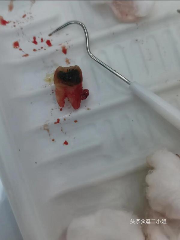拔牙的經歷