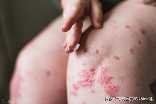 銀屑病患者應該怎麼抹藥和塗抹潤膚劑？