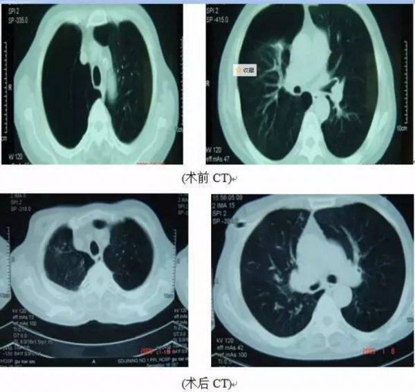 重度肺氣腫治不好只能等死？患者肺減容外科手術，讓你少走彎路