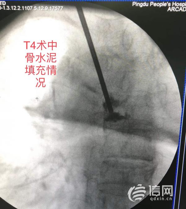高齡患者遭遇車禍 平度市人民醫院微創手術恢復健康