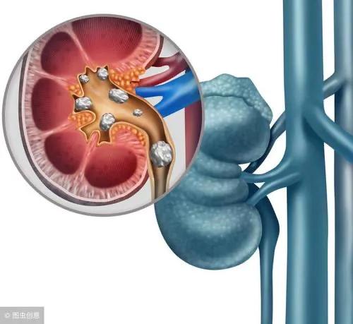 冬季並非腎結石“安全期”，預防腎結石的7種方法，哪種適合你？