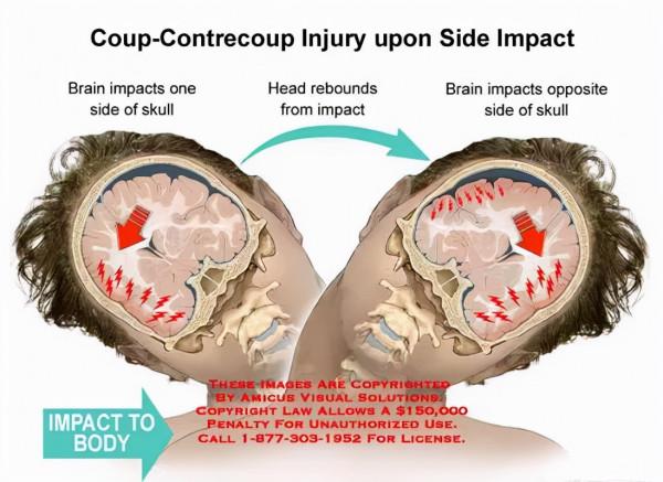 遭遇車禍,瀕死瞬間感覺不到痛,大腦還在放電影,有科學依據嗎? 遭遇車禍,瀕死瞬間感覺不到痛,大腦還在放電影,有科學依據嗎?