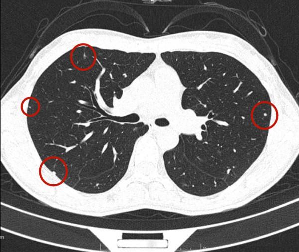 問診分析：兩肺多發實性結節，各科各醫院意見不一，如何是好？