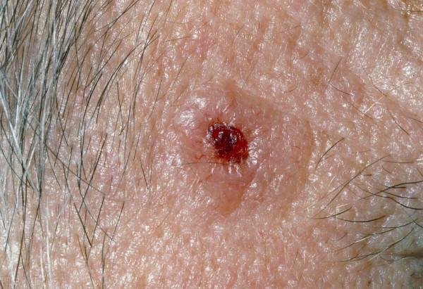 什麼原因導致的面板癌，瞭解一下