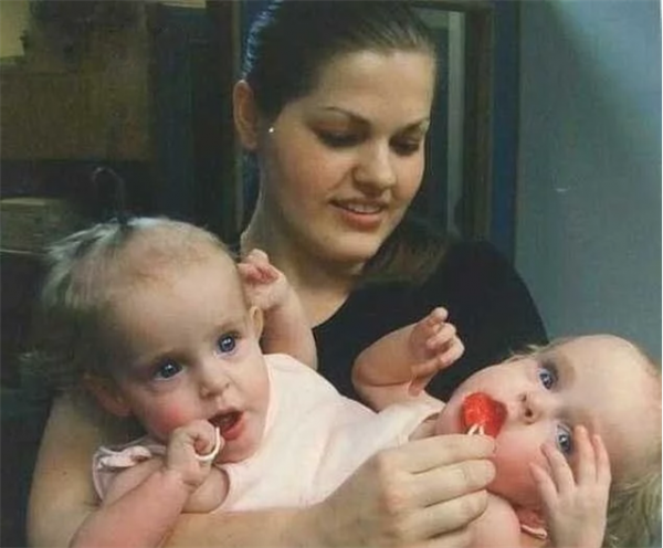 雙胞胎女嬰腹部相連醫生都說活不了，4歲做分離手術如今已滿20歲