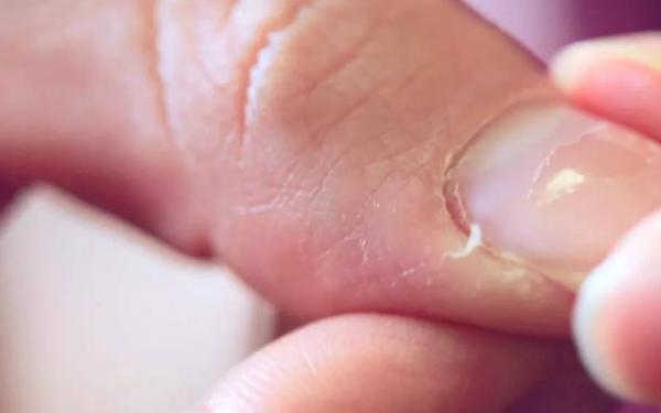 手上長不完的倒刺,真的是缺維生素嗎?教你3招,輕鬆去除倒刺 手上長不完的倒刺,真的是缺維生素嗎?教你3招,輕鬆去除倒刺