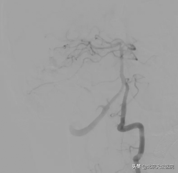 歷時9個半小時 動靜脈畸形出血少年轉危為安