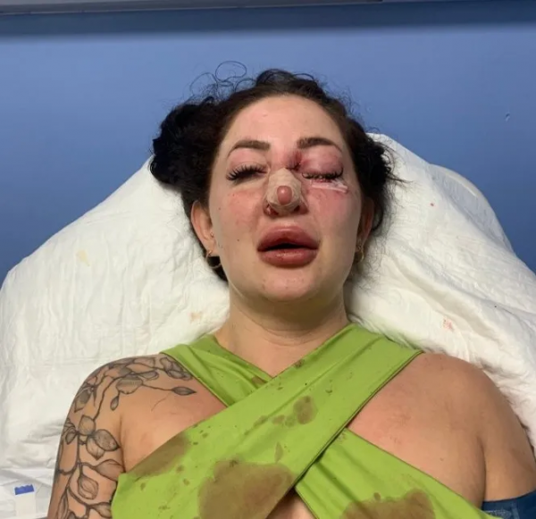 溫哥華美女旅遊勝地遭人痛毆毀容 險些癱瘓 施暴者竟是加拿大老鄉 溫哥華美女旅遊勝地遭人痛毆毀容 險些癱瘓 施暴者竟是加拿大老鄉