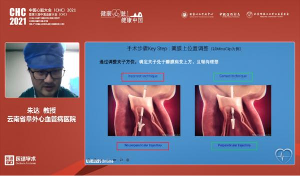 中國瓣膜病介入治療技術和研究盛況空前!CHC2021結構性心臟病論壇報道 中國瓣膜病介入治療技術和研究盛況空前!CHC2021結構性心臟病論壇報道